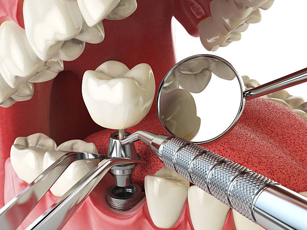 Best Emergency Dental Extractions in West Sacramento, CA